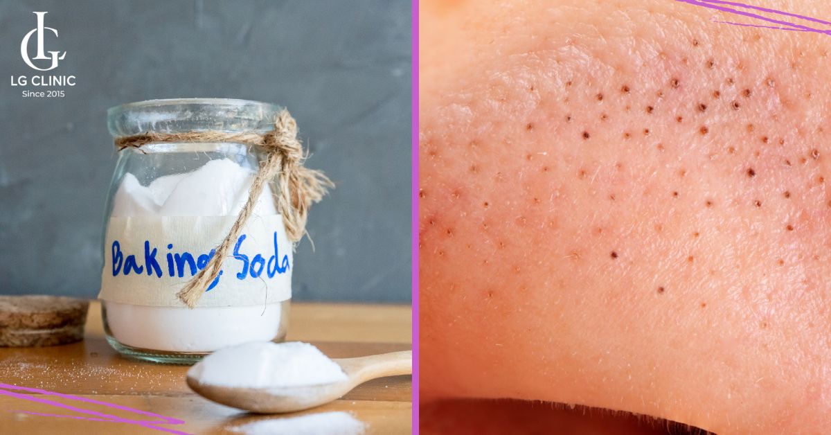 Baking soda trị mụn đầu đen hiệu quả