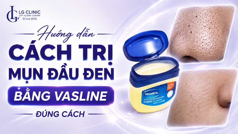 cách trị mụn đầu đen bằng vaseline