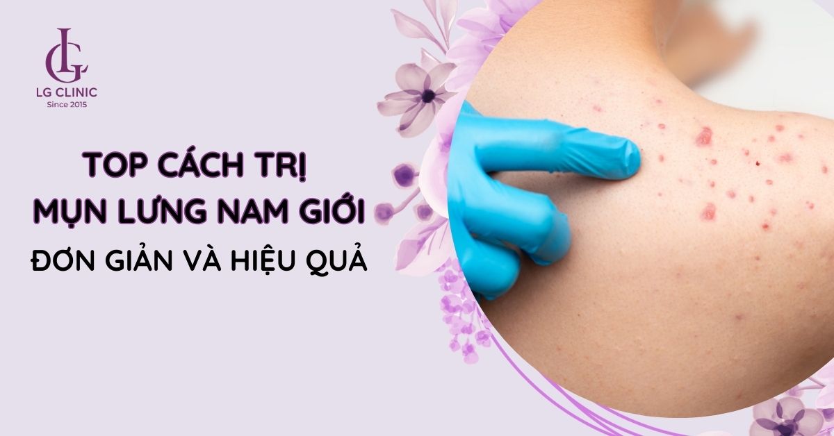 Top 13 cách trị mụn lưng nam giới đơn giản và hiệu quả