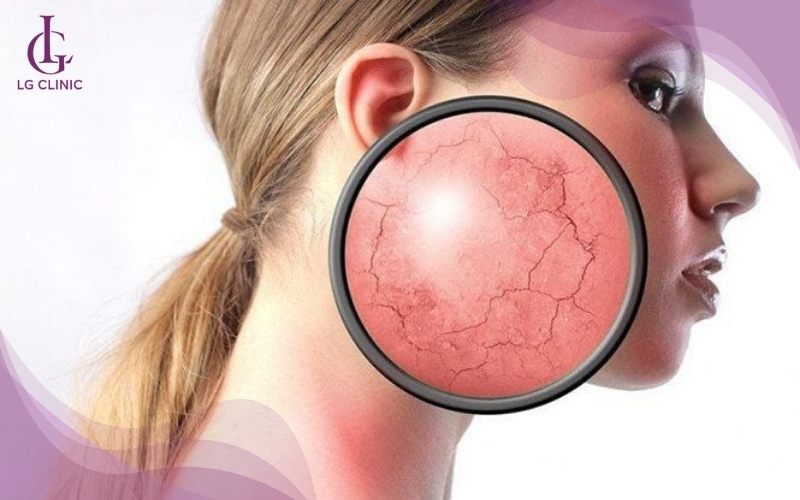 Da đang bị nhiễm corticoid do sử dụng nhiều mỹ phẩm độc hại