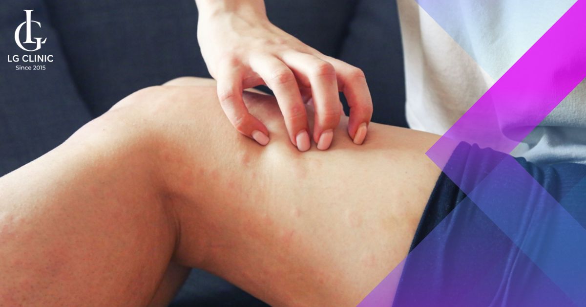 Không gãi lên khu vực da đang nổi mẩn đỏ