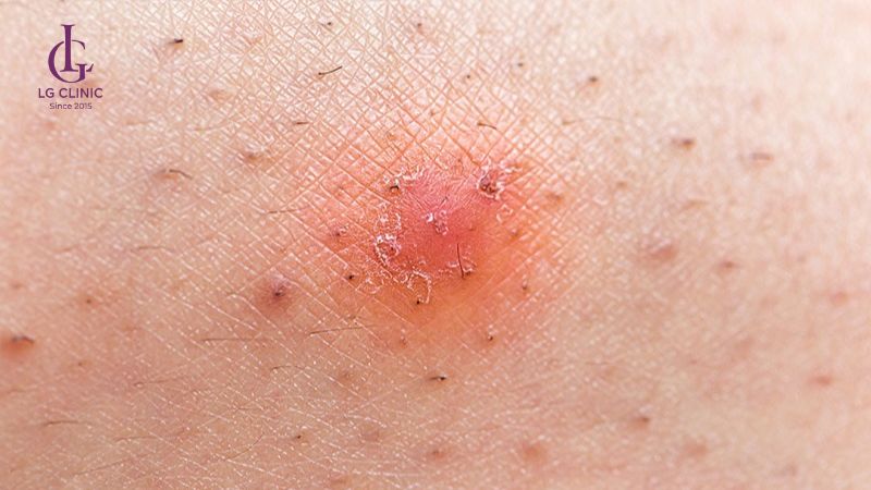 lông mọc ngược nếu tẩy lông sai cách