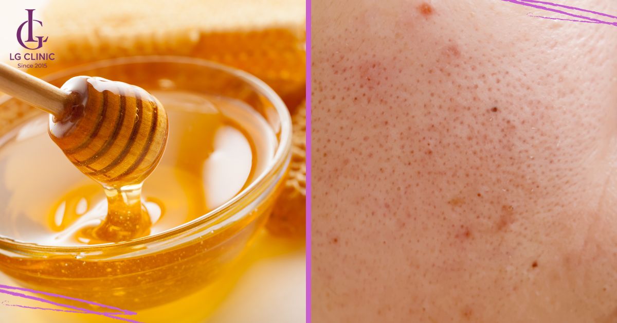 Mật ong hỗ trợ trị mụn đầu đen an toàn