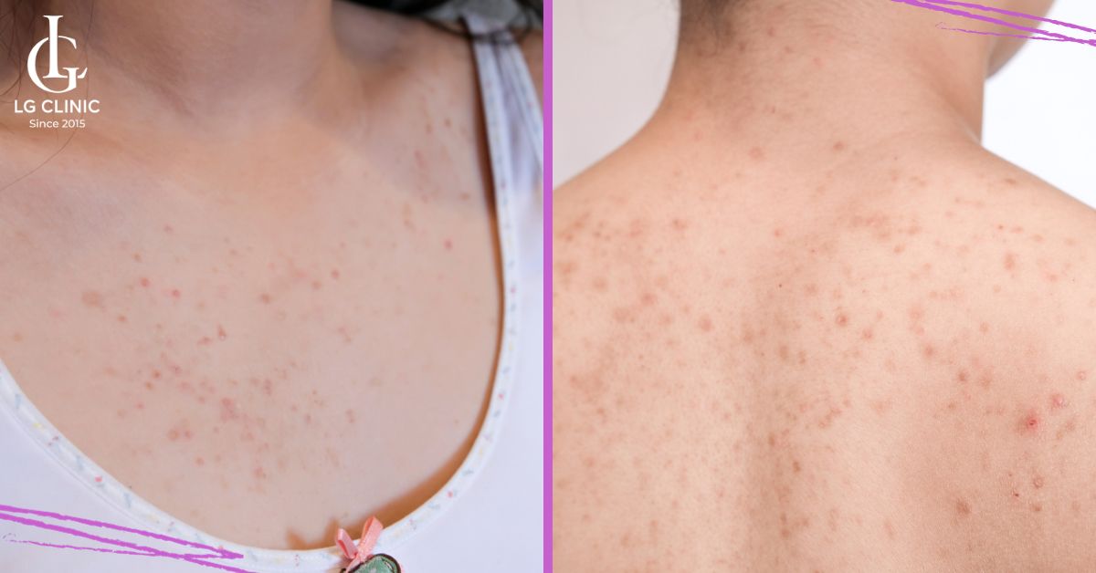 Mụn đầu đen hình thành ở vùng ngực và lưng