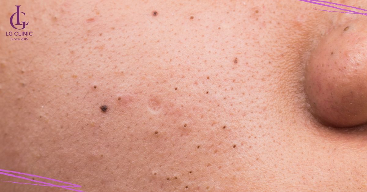 Mụn đầu đen ở khu vực má