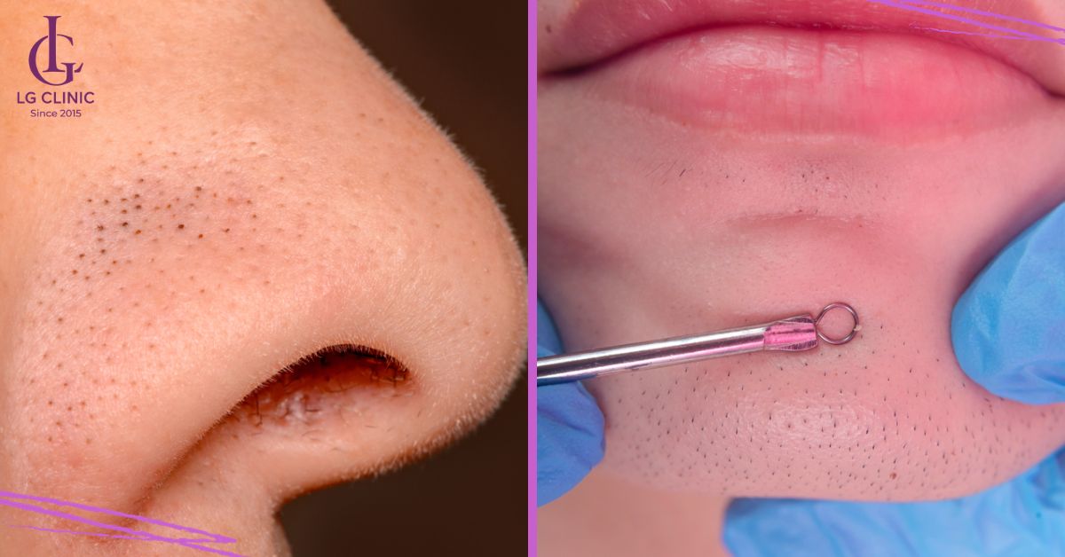 Mụn đầu đen ở vùng da mũi và cằm