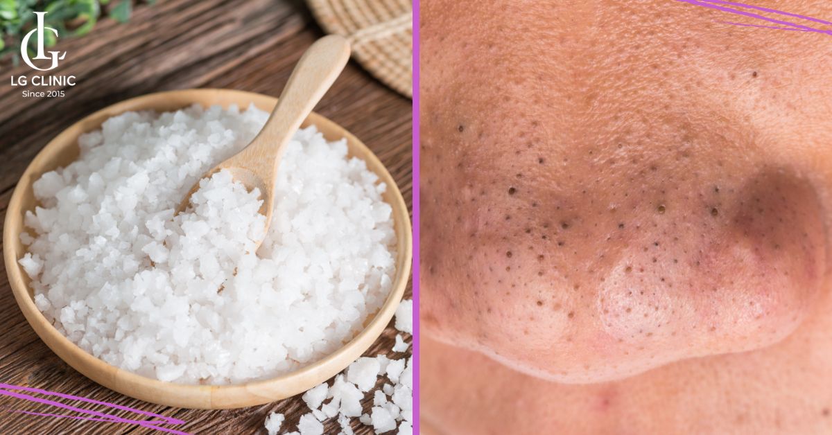 Muối giúp trị mụn đầu đen an toàn