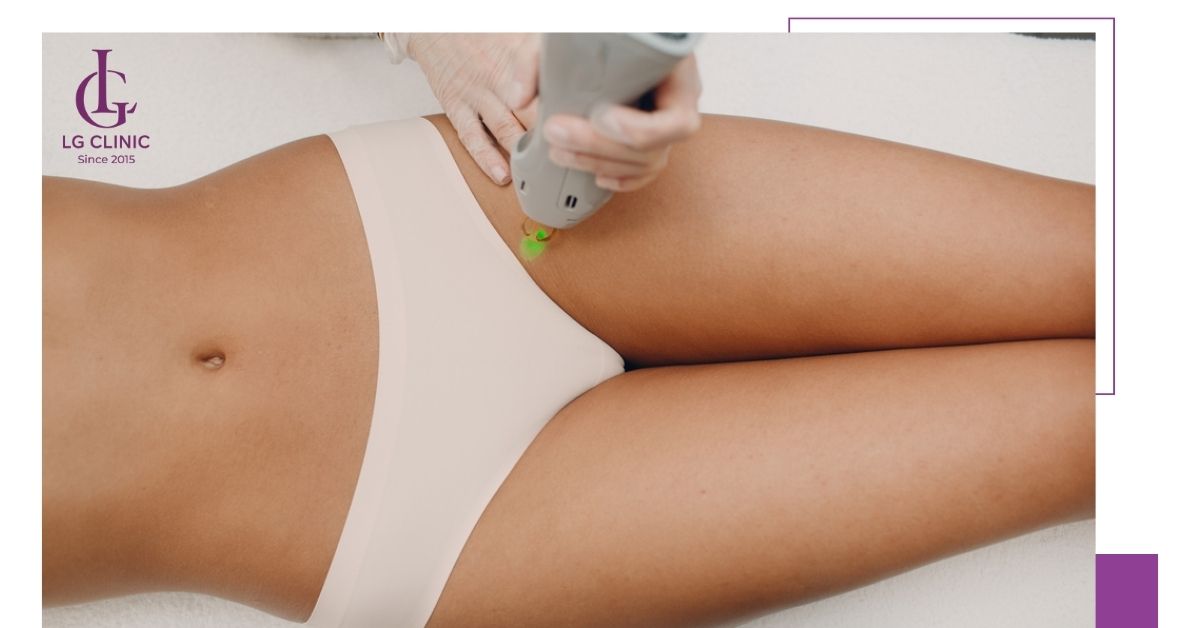 Nên tuân thủ phác đồ triệt lông vùng kín bằng laser từ đơn vị thẩm mỹ