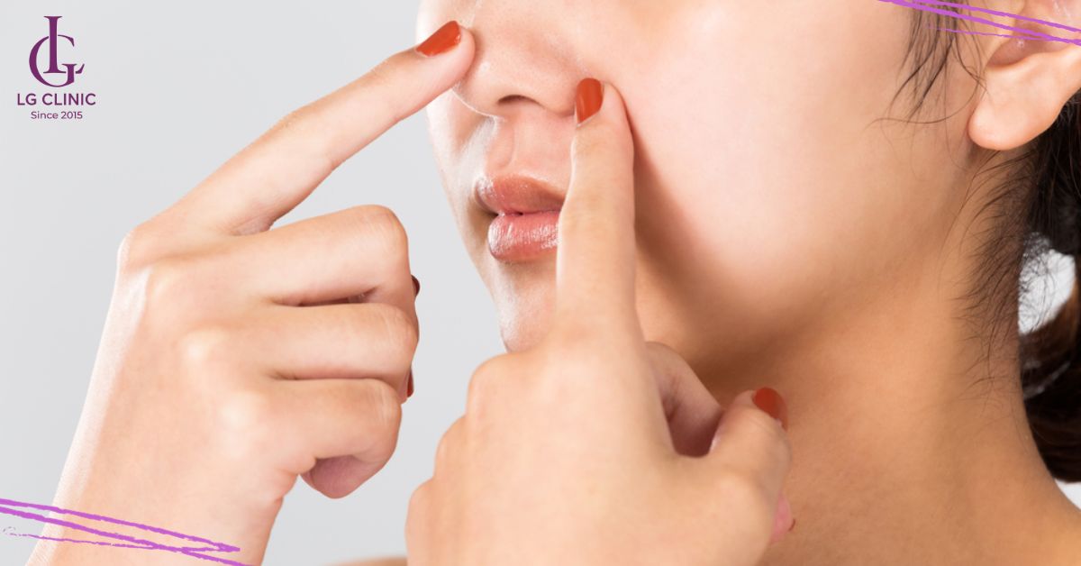 Người có tuyến bã nhờn sản xuất nhanh, liên tục dễ bị mụn đầu đen