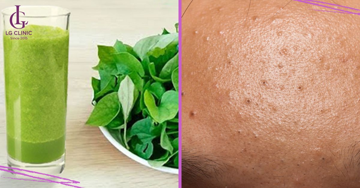 Rau diếp cá giúp trị mụn đầu đen tại nhà với hiệu quả tối ưu