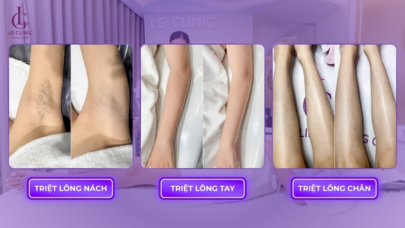 kết quả triệt lông