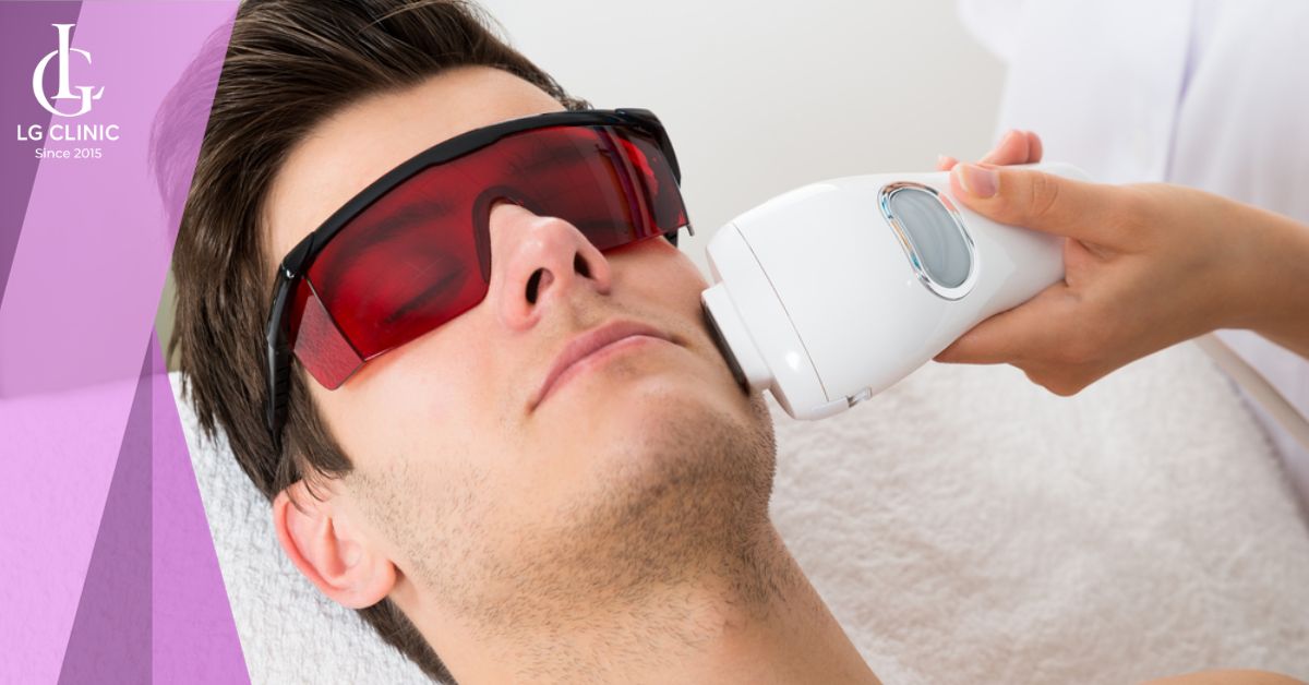 Sử dụng laser để triệt lông mặt cho nam