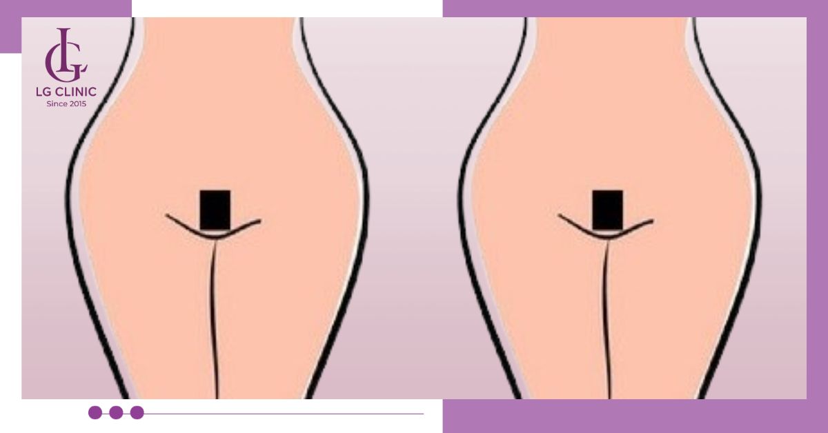 Tạo hình chữ nhật kiểu Pháp khi triệt lông