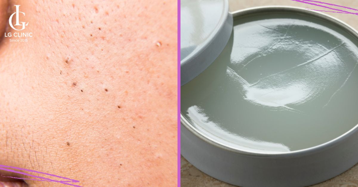 Trị hết mụn đầu đen với vaseline