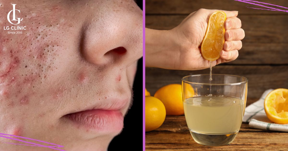 Trị mụn đầu đen an toàn với chanh