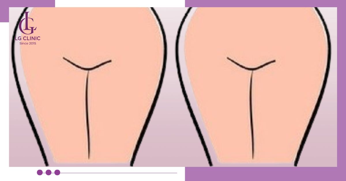 Triệt bikini tạo hình kiểu Hollywood