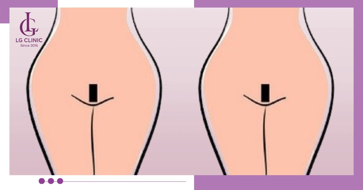 Triệt bikini với tạo hình kiểu Brazil