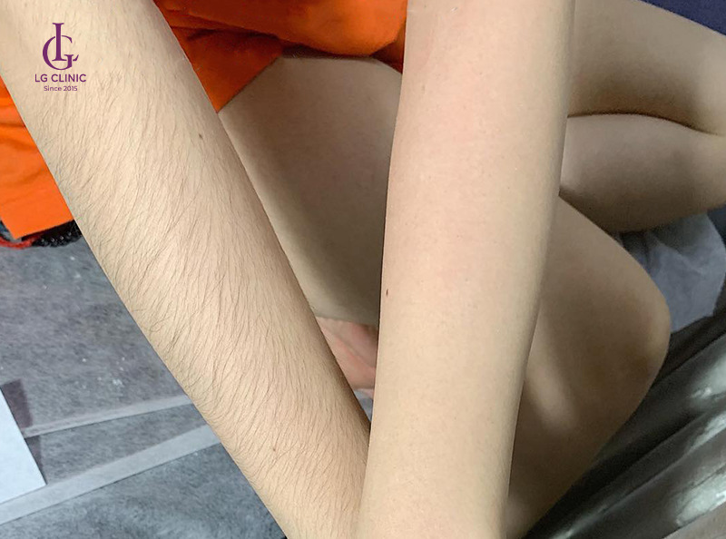 triệt lông 1/2 cánh tay