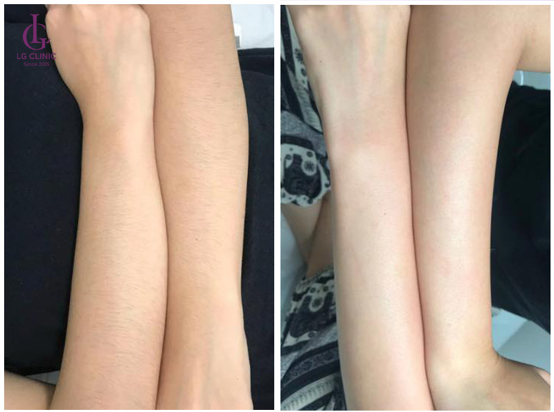 Hình ảnh triệt lông 1/2 cánh tay