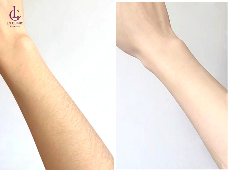 Hình ảnh sau khi triệt lông 1/2 cánh tay