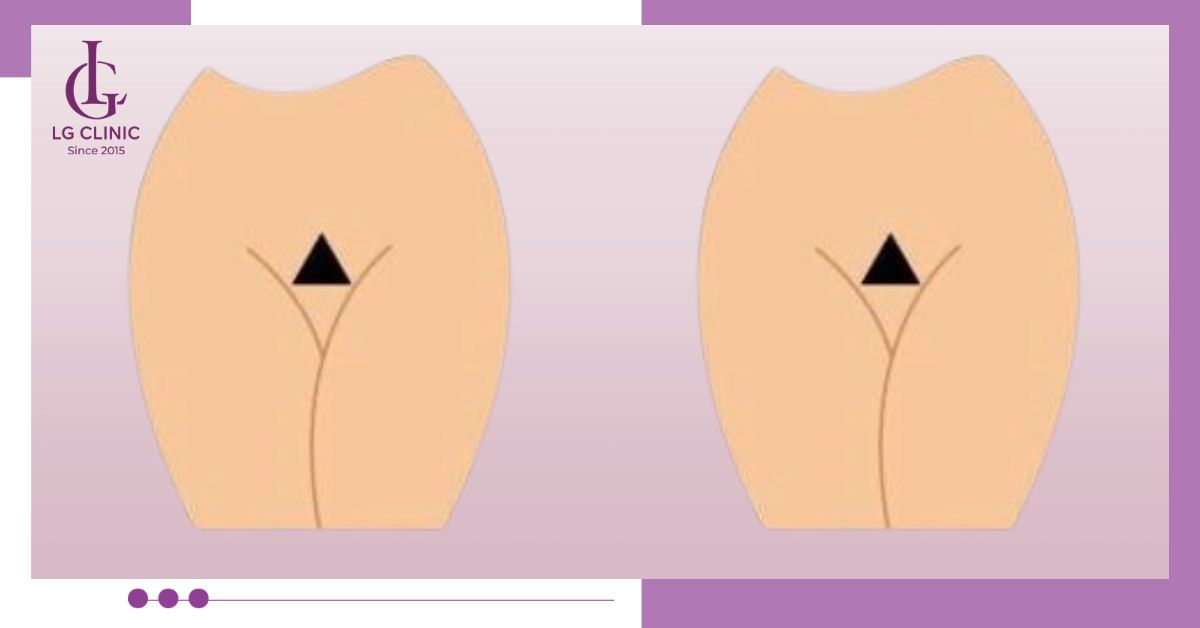 Triệt lông bikini tạo hình tam giác