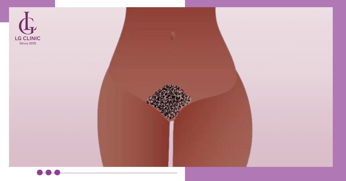 Triệt lông bikini với tạo hình kiểu bụi rậm