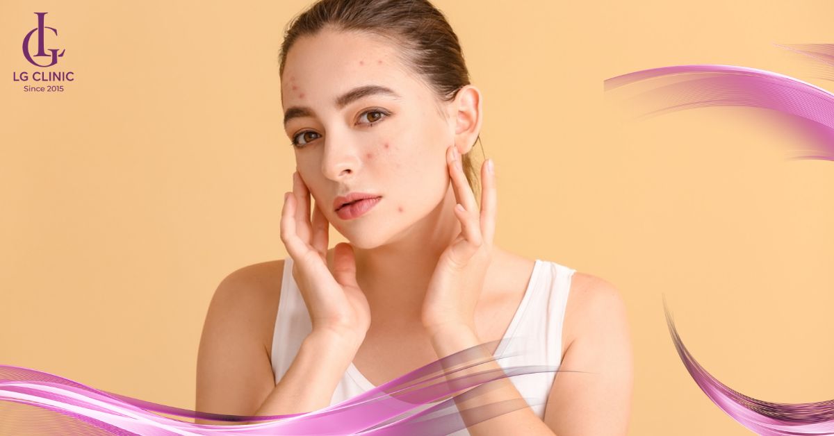 triet-long-mat-khi-da-dang-bi-mun-se-lam-mun-noi-nhieu-hon Triệt lông mặt khi da đang bị mụn sẽ làm mụn nổi nhiều hơn