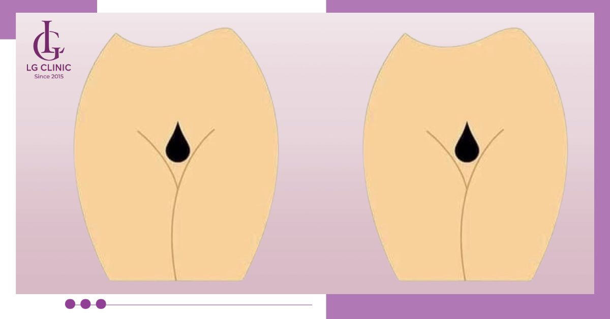 Triệt lông với tạo hình bikini giọt nước