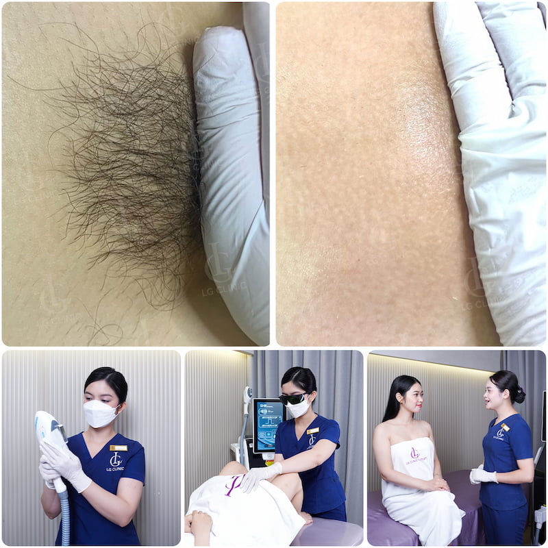 tỉa lông vùng kín nữ bằng kéo