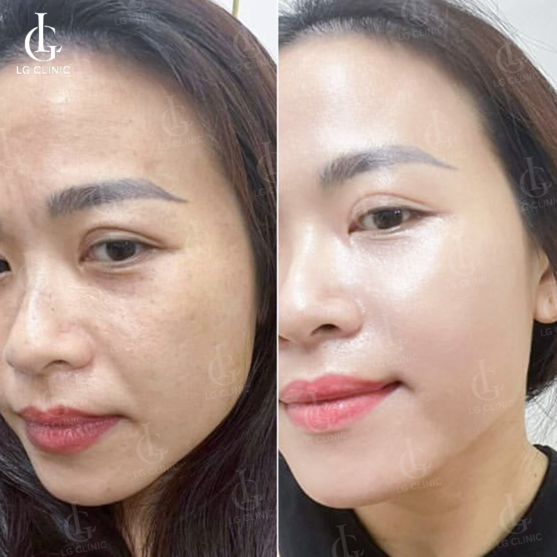 cấy trắng da mặt - cấy meso trắng da