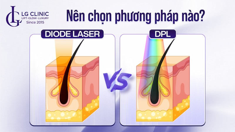 triệt lông dpl