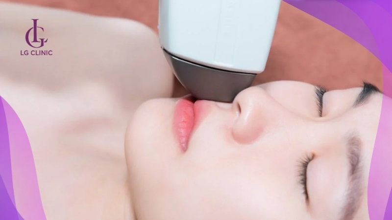 Tẩy ria mép bằng công nghệ laser