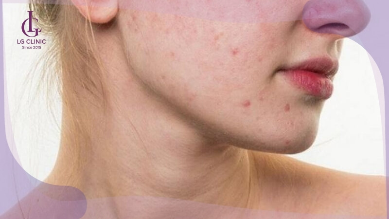 tác hại của kem trộn