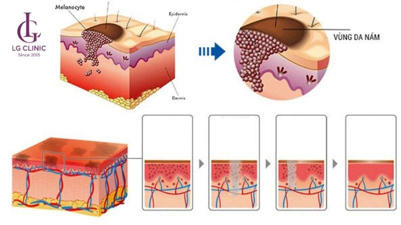 cơ chế hoạt động của laser trị thâm