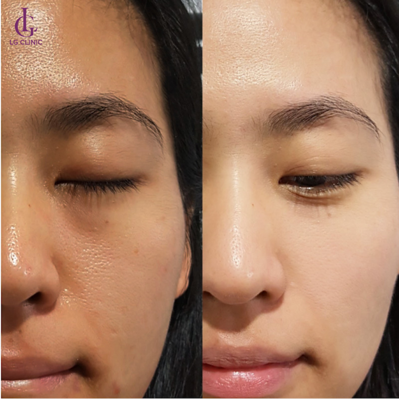 Khách hàng trước và sau khi thực hiện liệu trình Hydro Foam tại LG Clinic