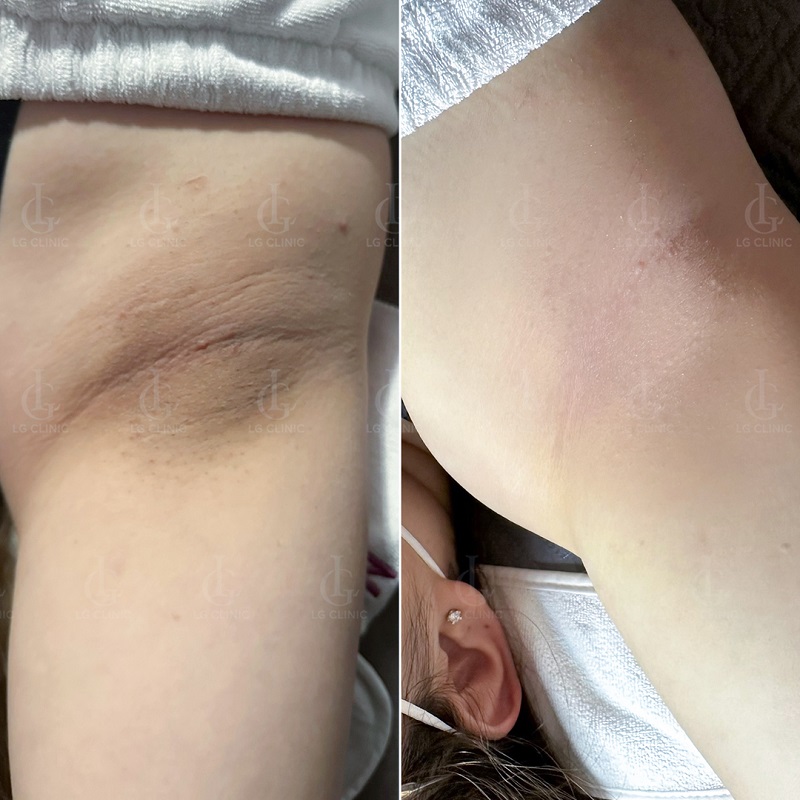 Công nghệ Deep L-Picosure giúp cải thiện vùng nách thâm hiệu quả