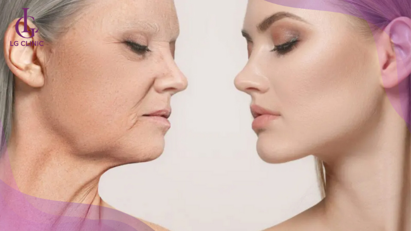 Da mặt chùng nhão, nhiều nếp nhăn nên thực hiện nâng cơ bằng sóng RF