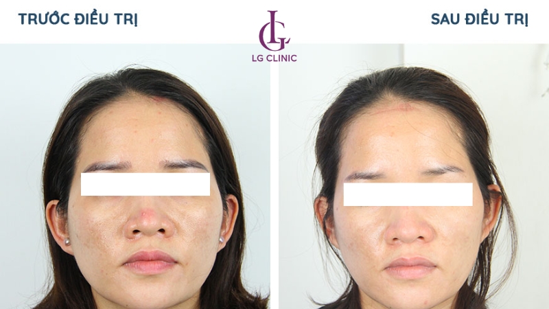Trước và sau khi thải độc da bằng công nghệ Hydro Foam tại LG Clinic
