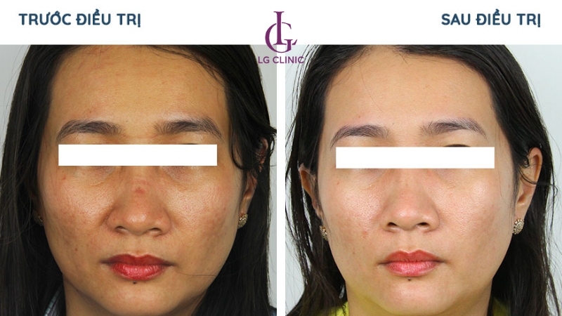 Tình trạng da cải thiện đến 80% trắng sáng hơn với liệu trình Hydro Foam tại LG Clinic