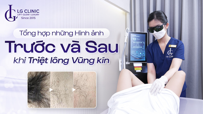 hình ảnh triệt lông vùng kín
