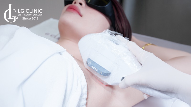 thời gian triệt lông nách cách nhau bao lâu