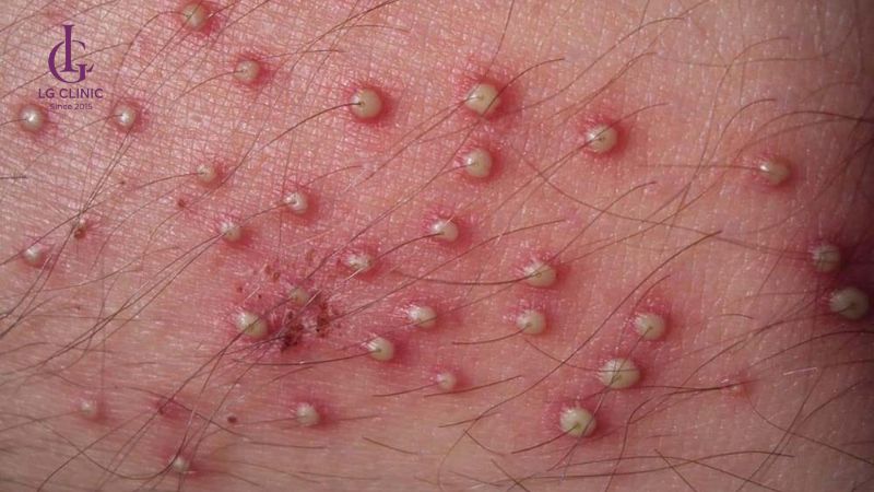 wax lông vùng kín bị viêm lông