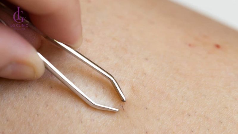 cách nhổ lông vùng kín tại nhà