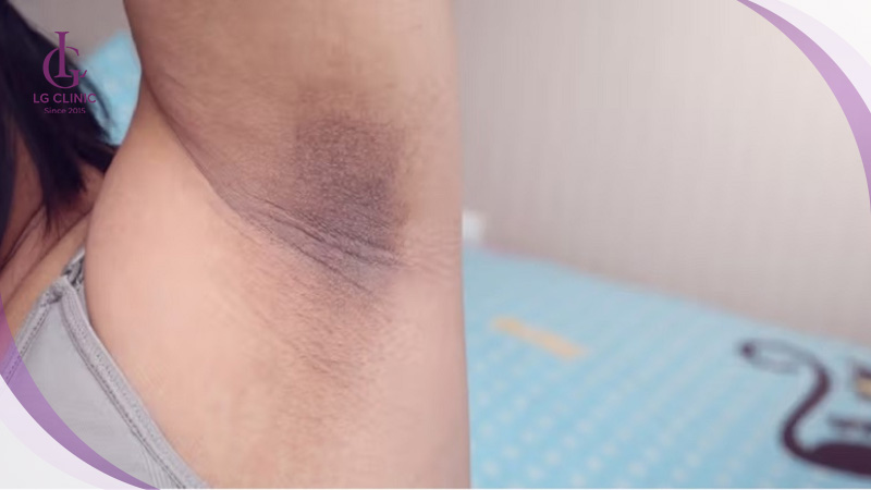 cách trị thâm nách trong 3 ngày