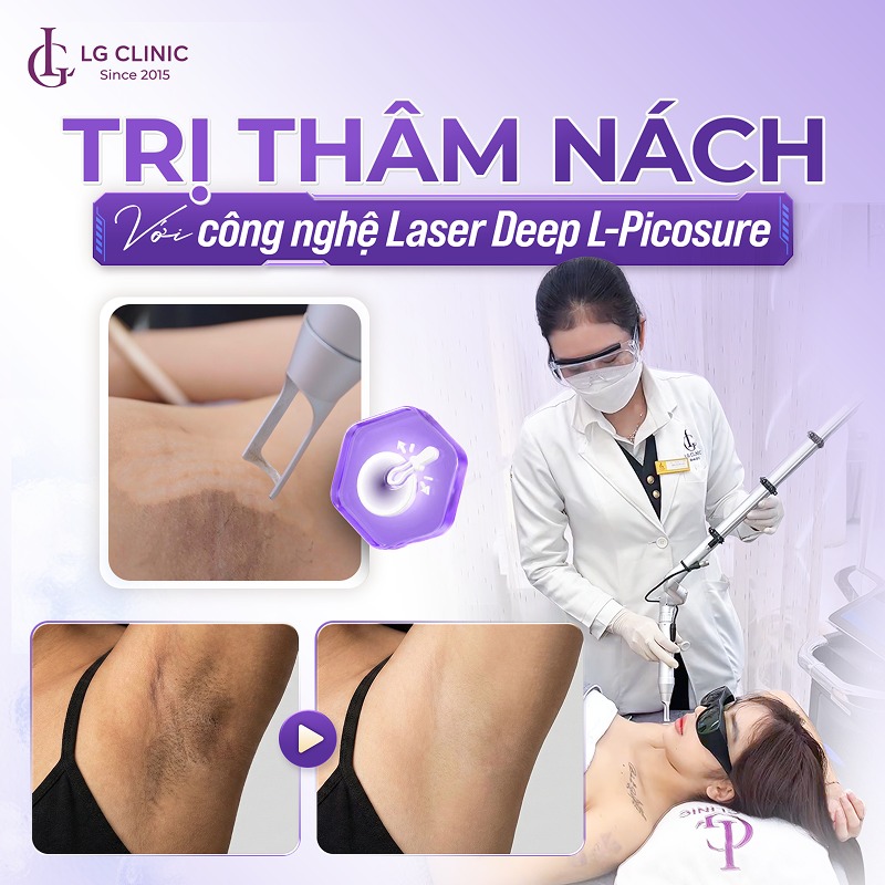cách trị thâm nách