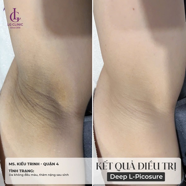 giá trị thâm nách
