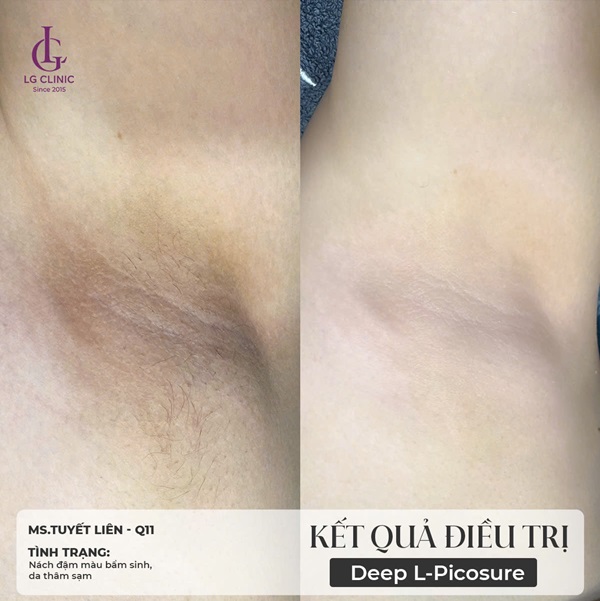kết quả trị thâm nách