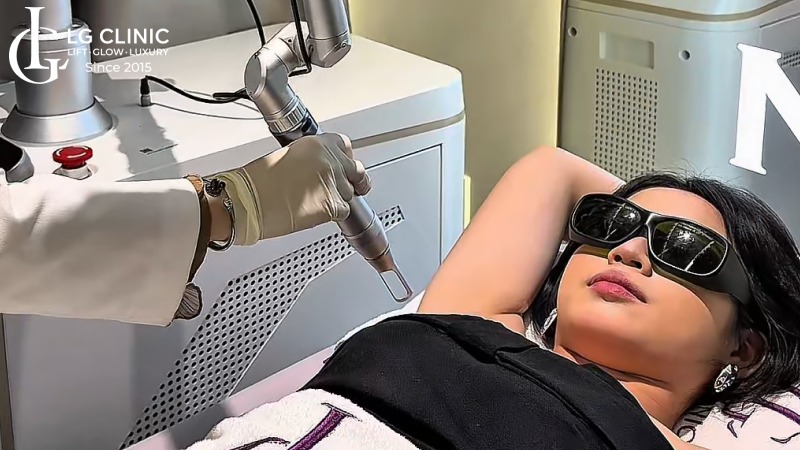 trị thâm nách bằng laser