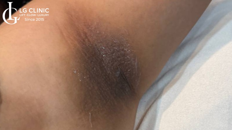 trị thâm nách bằng laser