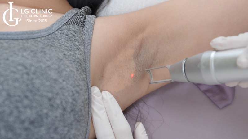 trị thâm nách bằng laser